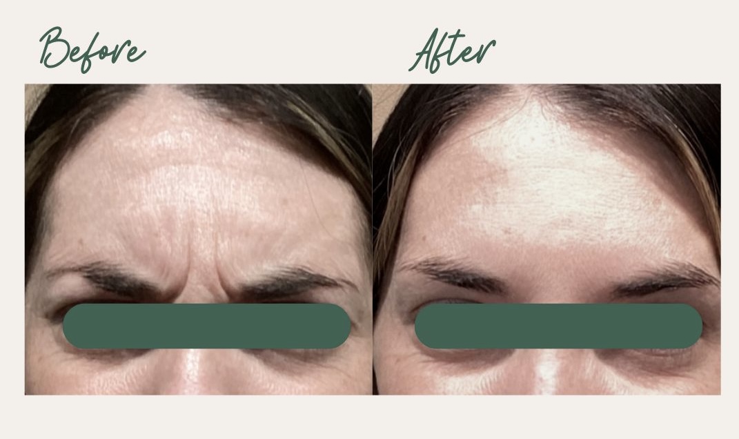 Frown Lines Treatment
