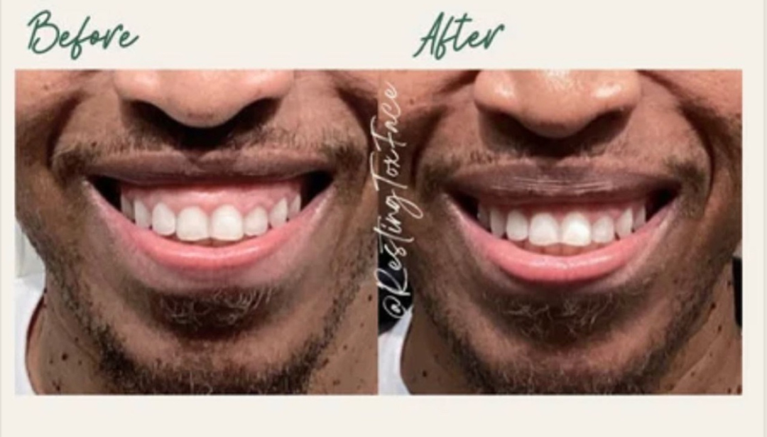 Gummy Smile Treatment