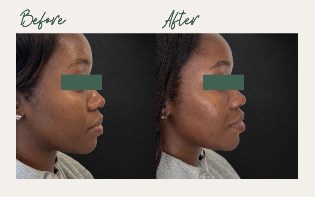 Cheeks and Nasolabial Folds