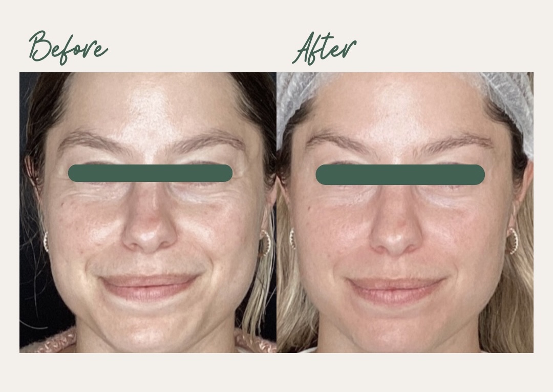 Before and After Microneedling