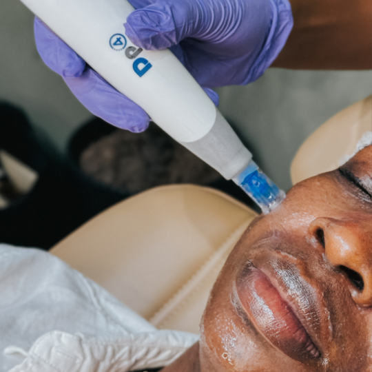 Microneedling